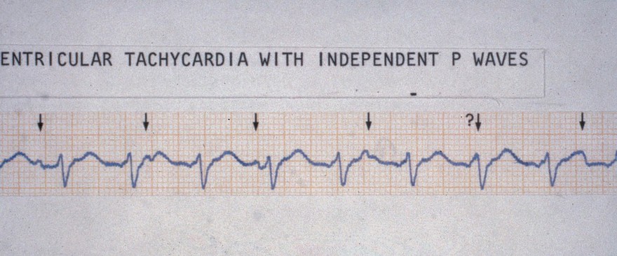 Tachycardia ventricular, with independent P waves