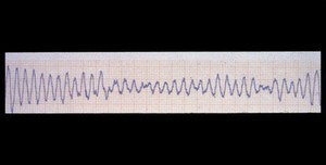 view Fibrillation, ventricular