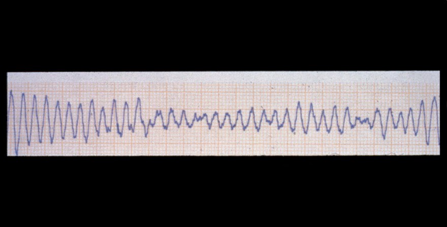 Fibrillation, ventricular