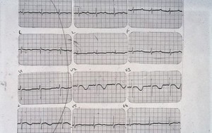 view QT syndrome, long