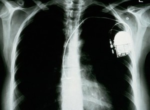 view Pacemaker, atrial anti tachycardia