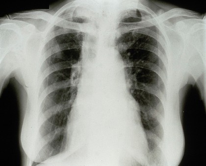 Mitral stenosis, moderate