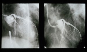 view Angioplasty, left coronary artery, pre and post