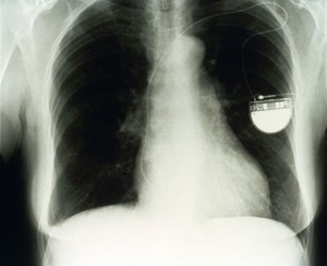 view Pacemaker, modern small ventricular