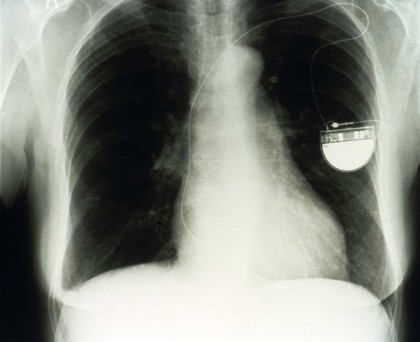 Pacemaker, modern small ventricular