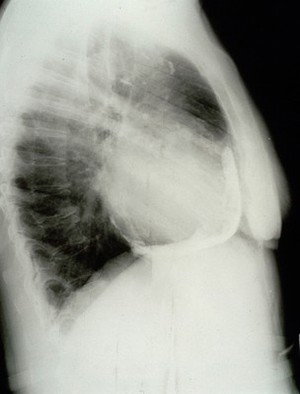 view Calcification, pericardial