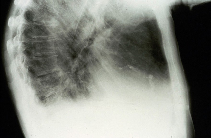 Calcification, coronary artery
