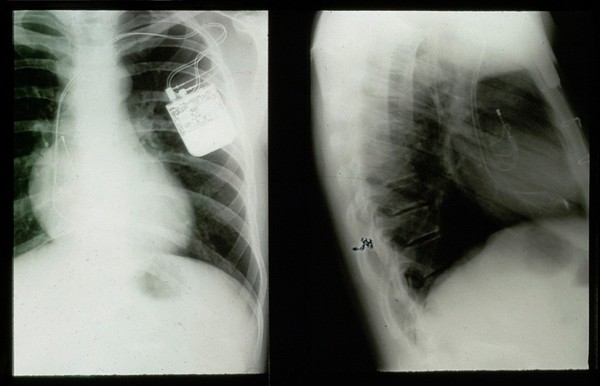 Pacemaker, dual chamber