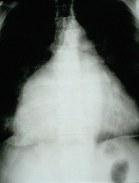 Mitral stenosis, severe, longstanding