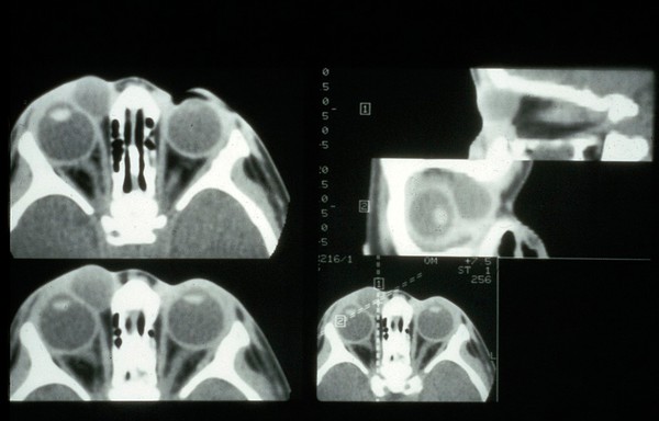 Dermoid, orbital