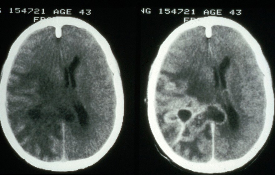 MRI scan; brain cancer (glioma)