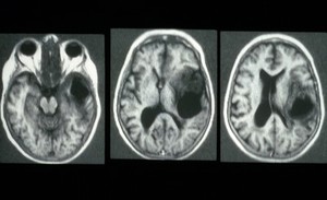 view CT scans; brain cancer (glioma), right temporal lobe