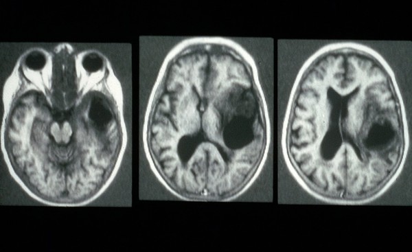 CT scans; brain cancer (glioma), right temporal lobe