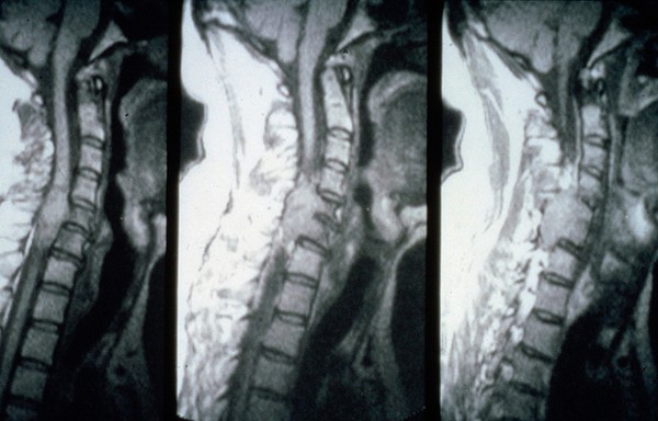 Neurofibroma, C5