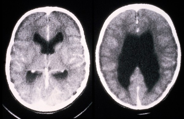 Chiari ventricles