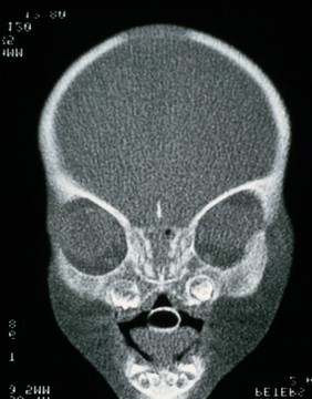 Apert's syndrome