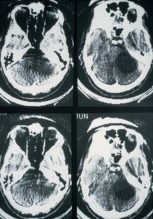 view Neuroma, cystic acoustic