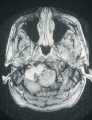 view Glomus tumour