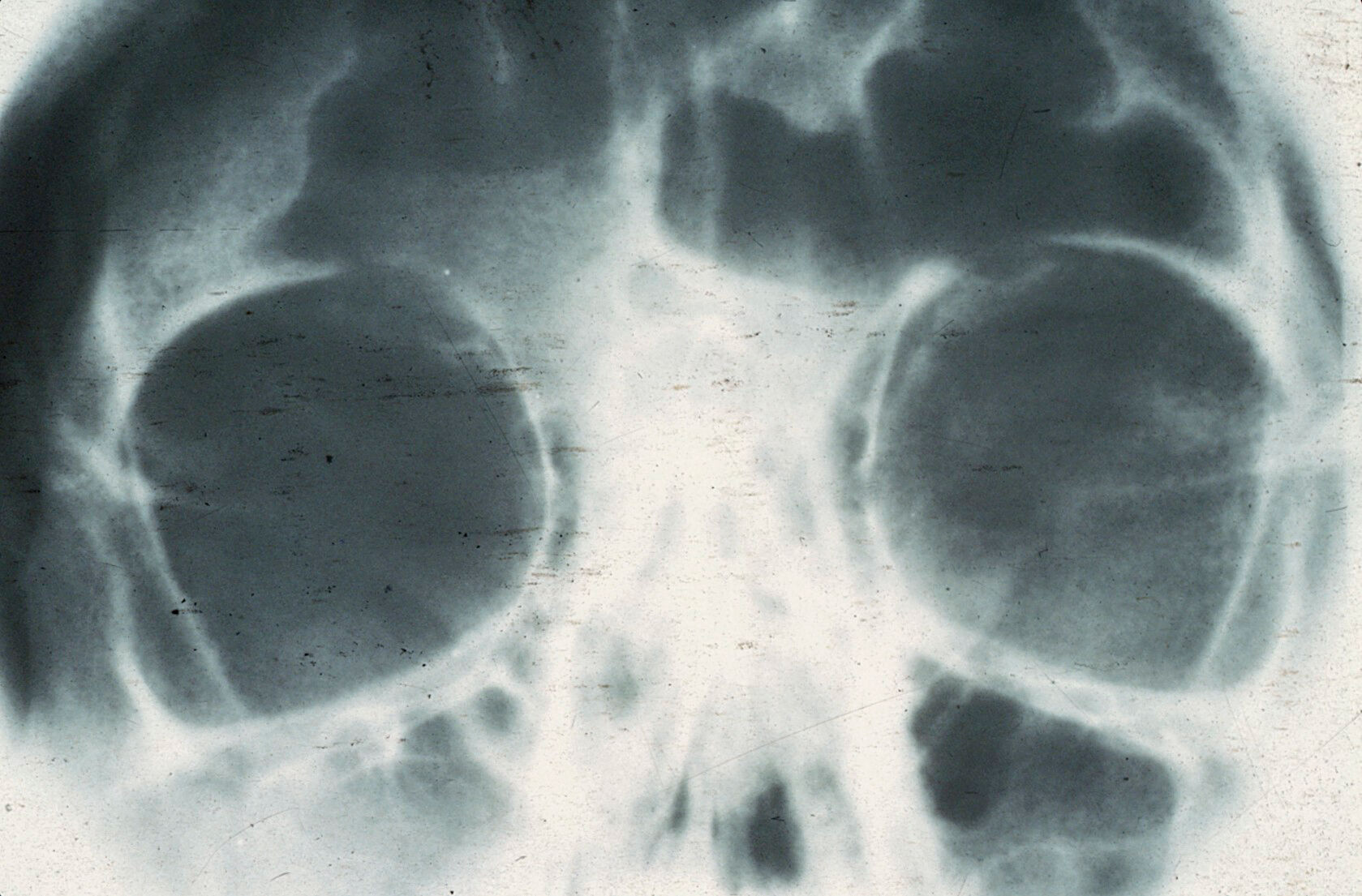 Headache And The Frontal Sinus