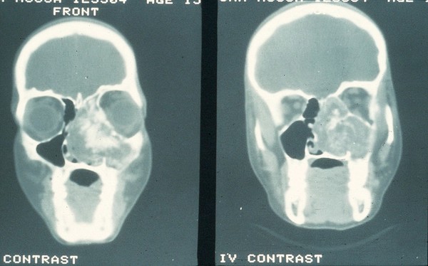 CT scan showing esthesioneuroblastoma