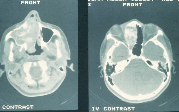 CT scan showing esthesioneuroblastoma