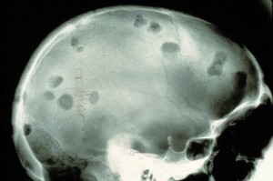 view Tuberculosis skull, "button" lesions