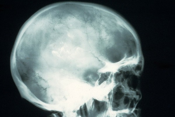 X-ray; brain cancer (oligodendroglioma)