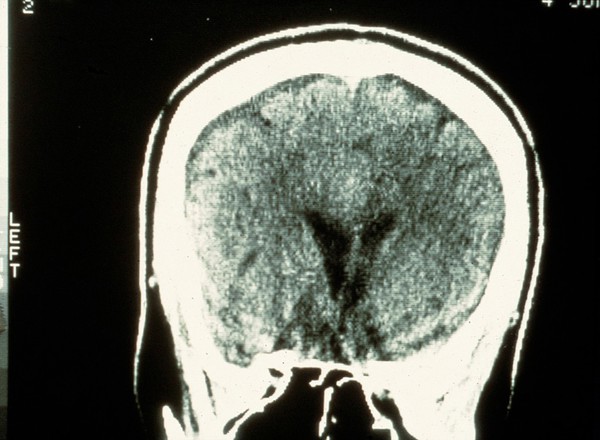 Haematoma, chronic subdural