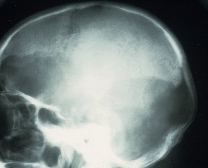 Osteoporosis circumscripta, skull