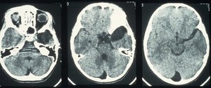 view Cyst, arachnoid, temporal