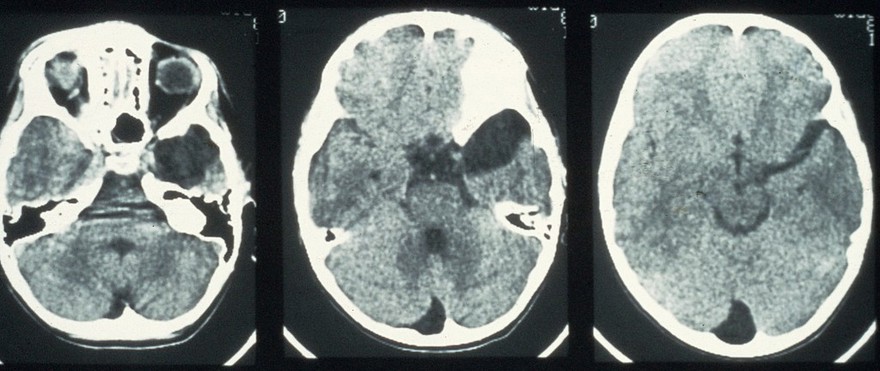 Cyst, arachnoid, temporal