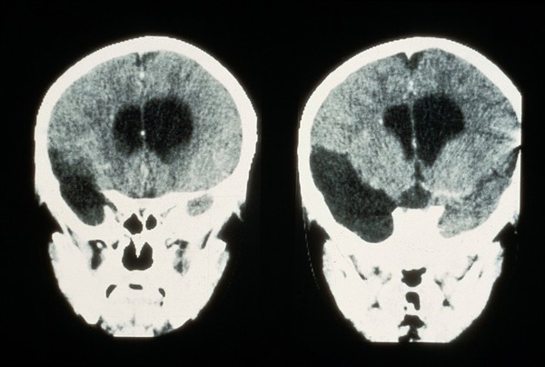 Cyst, arachnoid temporal fossa