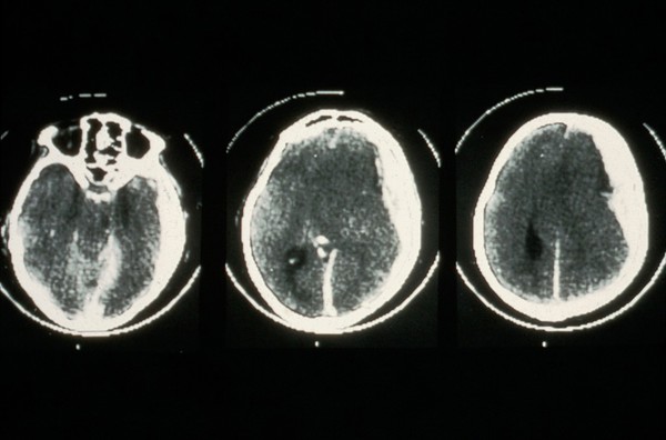 Haematoma, subdural with gross swelling