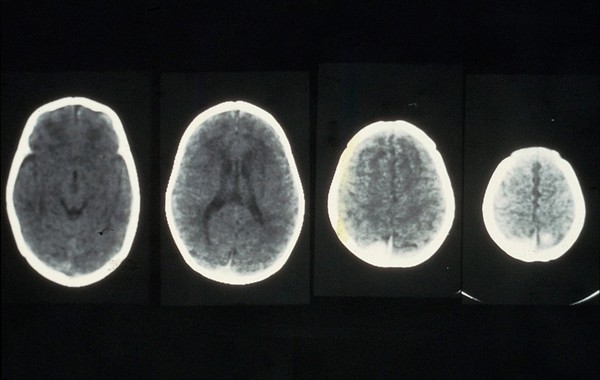 Haematoma, acute subdural