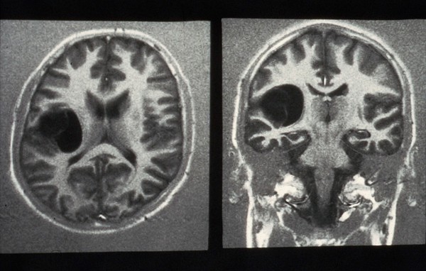 MRI scan; brain cancer (glioma)