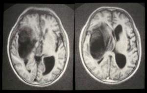 view MRI scan; brain cancer (glioma)