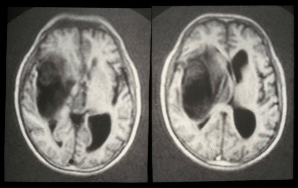 MRI scan; brain cancer (glioma)