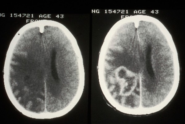 CT scan; brain cancer (glioma), pre-treatment