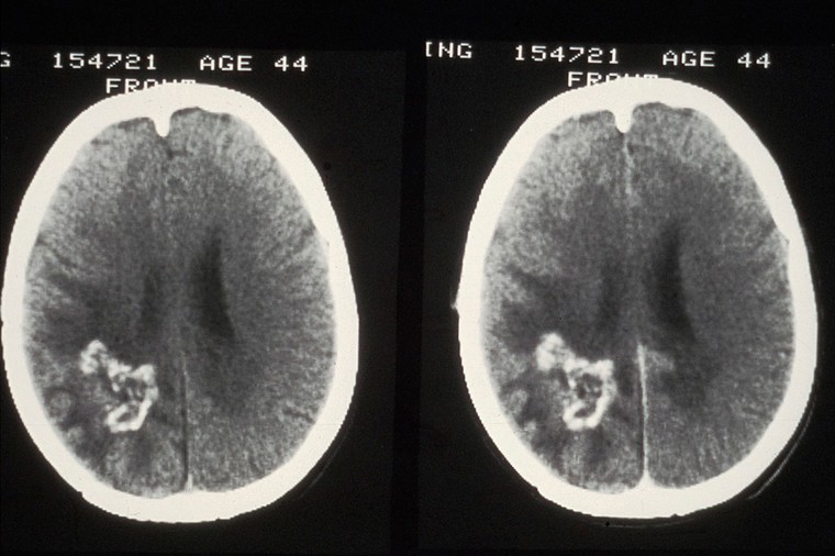 CT scan; brain cancer (glioma), post-treatment | Wellcome Collection