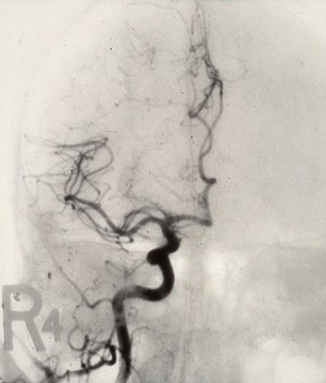 view Cerebral angiogram; brain cancer (fronto-parietal)