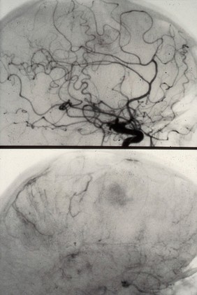 Cerebral angiogram; brain cancer (fronto-parietal)