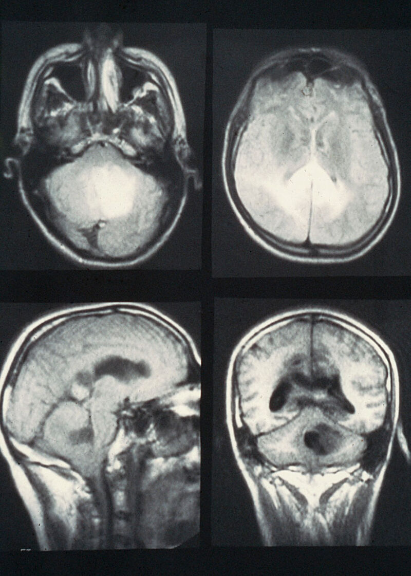 MRI scan; brain cancer (glioblastoma) | Wellcome Collection
