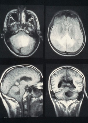 view MRI scan; brain cancer (glioblastoma)