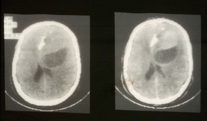 view CT scan; brain cancer (oligodendroglioma)