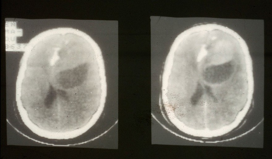 CT scan; brain cancer (oligodendroglioma)