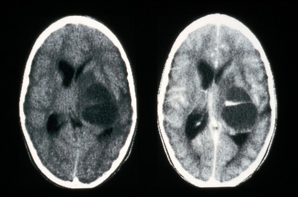 CT scan; brain cancer (glioma)