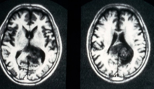 MRI scan; brain cancer (glioma)