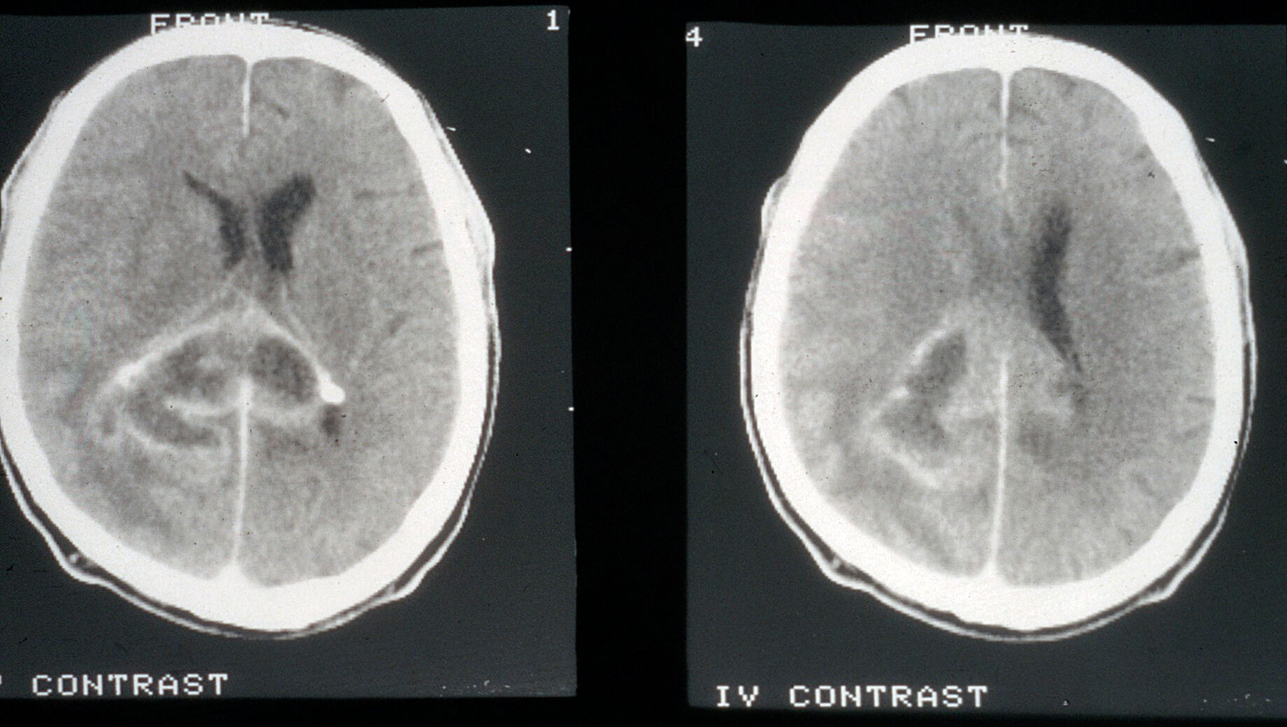 CT scan; brain cancer (glioma) | Wellcome Collection