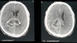 view CT scan; brain cancer (glioma)