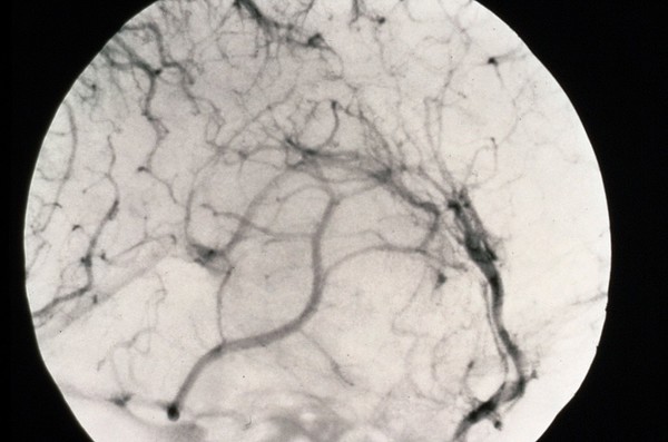 Cerebral angiogram; brain cancer (meningioma)